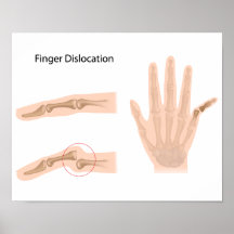 Affiche de dislocation de doigt