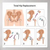 Affiche totale de chirurgie de remplacement de han