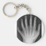 Polydactyly, six mains digitées, rayon X, rareté ! Porte-clé