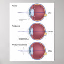 Recherche de opticien posters Optométrie
