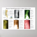 Zoek naar lumbal posters Wervelkolom