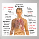 Recherche de globule rouge Anémie