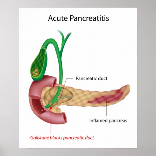 Acuut Pancreatitis Poster (Voorkant)