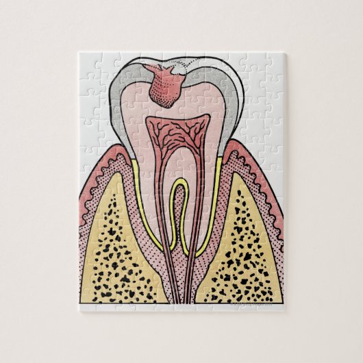 Afbeelding kruissectie met tandbederf legpuzzel (Verticaal)