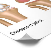 Affiche de chirurgie de remplacement du genou (Coin)