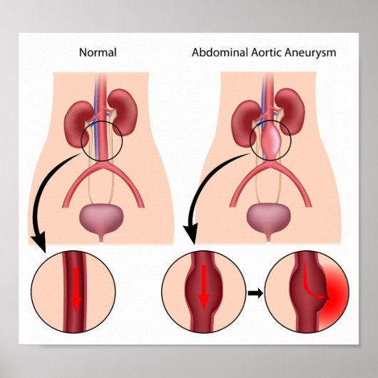 Affiche de l'aortique abdominale (Devant)
