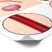 Affiche de l'aortique abdominale (Coin)
