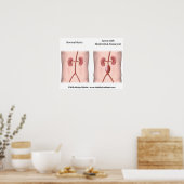 Affiche de l'aortique abdominale (Cuisine)