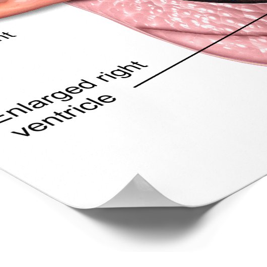 Affiche d'hypertension pulmonaire (Coin)