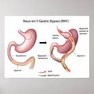 affiche gastrique de chirurgie de la déviation