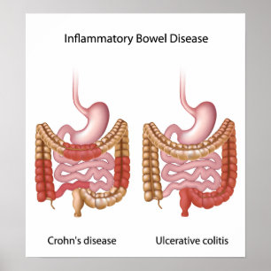 affiche inflammatoire (ibd) de maladie intestinale