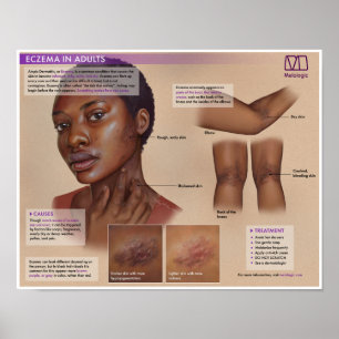 Affiche Médicale de l'eczéma Melalogique
