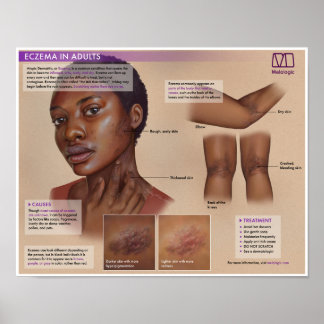 Affiche Médicale de l'eczéma Melalogique
