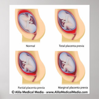 Affiche Placenta prea