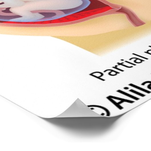 Affiche Placenta prea (Coin)