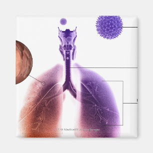 Aimant Illustration d'une crise d'asthme de pollen