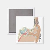 Aimant Implants cochléaires (Recto/Verso)