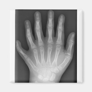 Aimant Polydactyly, six mains digitées, rayon X, rareté