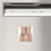 Aimant Transplantation rénale (In Situ (Lave-vaisselle))
