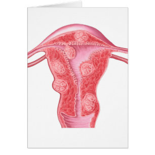 Anatomie Des Tumeurs Fibroïdes Dans L'Utérus Fémin