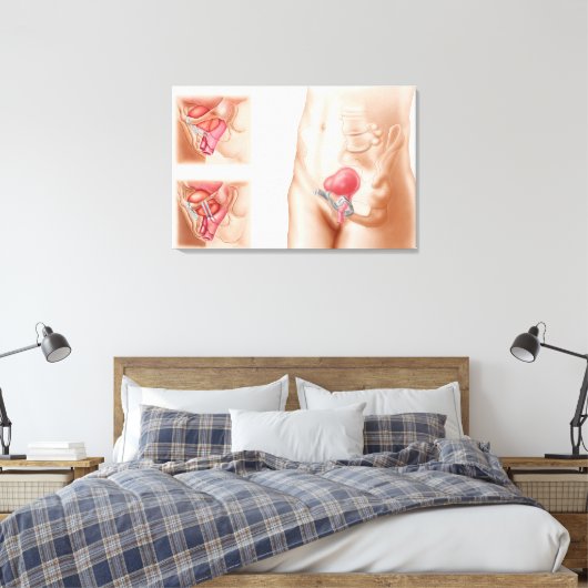 Anatomie van een blaasophanging canvas afdruk (Insitu (Slaapkamer))