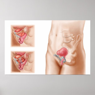 Anatomie van een blaasophanging poster