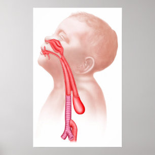 Anatomie van een tracheesophageale fistels poster