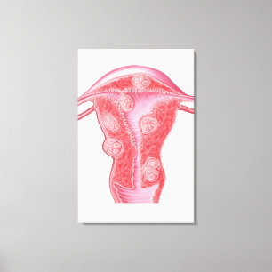Anatomie van fibroïde tumoren in de baarmoeder va canvas afdruk