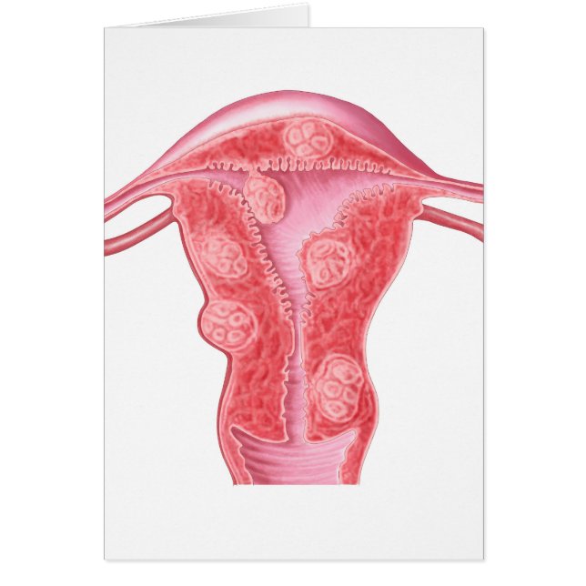 Anatomie van fibroïde tumoren in de baarmoeder van (Voorkant)