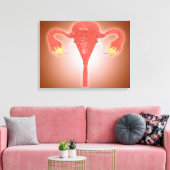 Anatomie van Vrouw baarmoeder met eierstokken Canvas Afdruk (Insitu (Woonkamer))