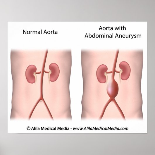 Aneurysme poster (Voorkant)