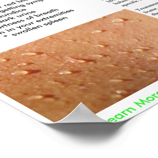 Babesia Symptômes and Transmission Poster (Coin)