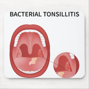 Bacteriële tonsillitis muismat