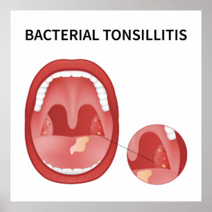 Bacteriële tonsillitis poster
