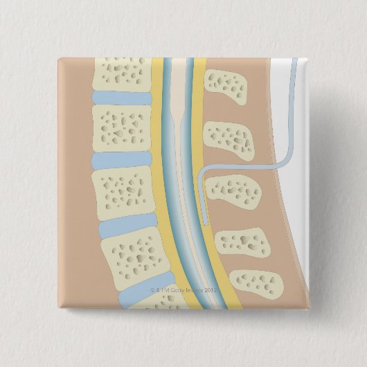 Badge Carré 5 Cm Anesthésie épidurale (Devant)