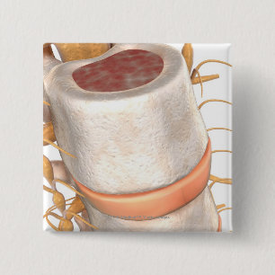 Badge Carré 5 Cm Fermez-vous d'un disque invertebral dans l'épine