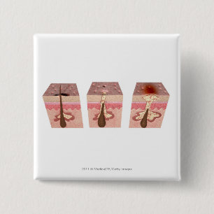 Badge Carré 5 Cm Vue de ce qui cause l'acné