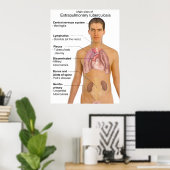 Belangrijkste symptomen van extrapulmonale tubercu poster (Thuiskantoor)