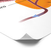 Benigne prostaathyperplasie Poster (Hoek)