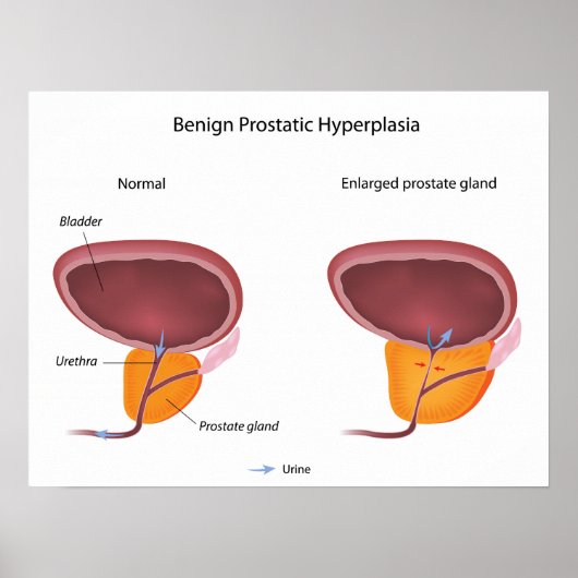 Benigne prostaathyperplasie Poster (Voorkant)