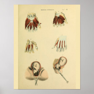 Birth Forceps Obstetrics Anatomic Medical Art Prin Poster