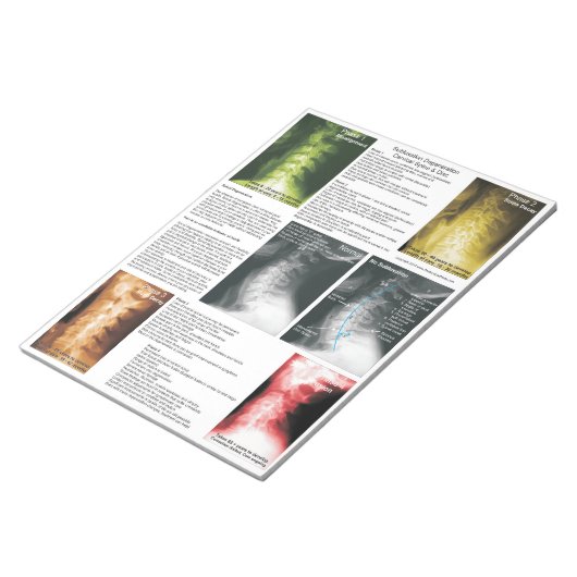 Bloc-note Éteindre la subbluxation de Pad Dégénération cervi (Incliné)