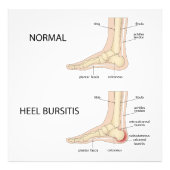 Bursitis calcanealis foto afdruk (Voorkant)