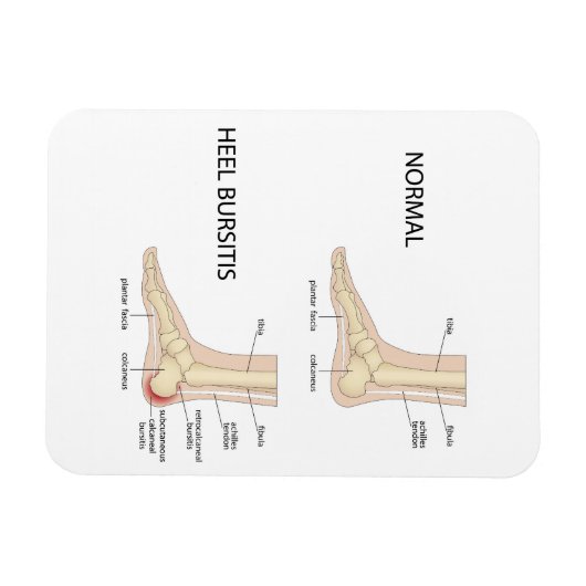 Bursitis calcanealis magneet (Horizontaal)