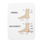 Bursitis calcanealis magneet (Verticaal)