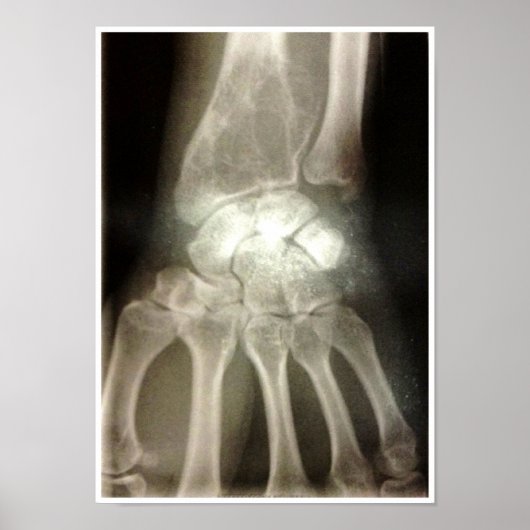 Carpals Xray Poster (Voorkant)
