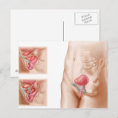 Carte Postale Anatomie De La Procédure De Suspension De Vessie (Devant / Derrière)