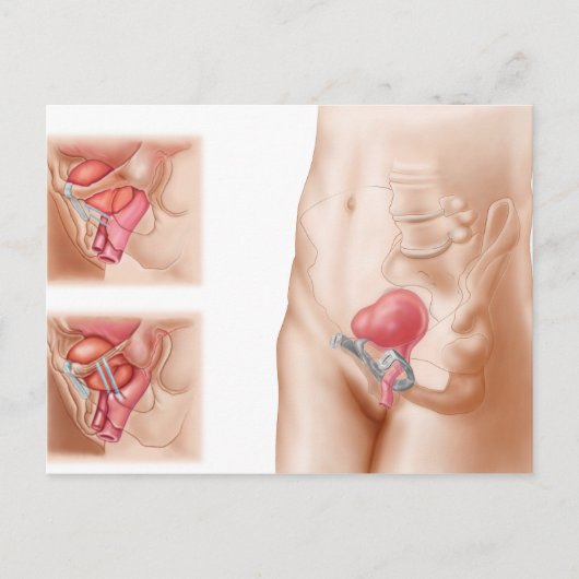 Carte Postale Anatomie De La Procédure De Suspension De Vessie (Devant)