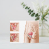 Carte Postale Anatomie De La Procédure De Suspension De Vessie (Debout devant)