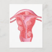 Carte Postale Anatomie Des Tumeurs Fibroïdes Dans L'Utérus Fémin (Devant)